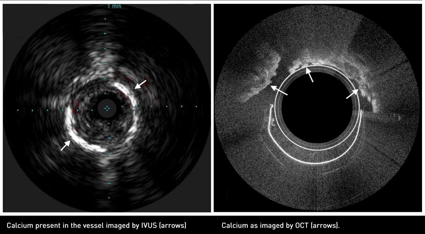 OCT vs IVUS The Results Are In