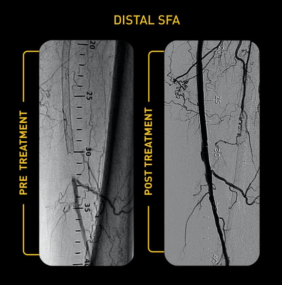 Distal SFA-1