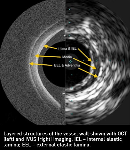 OCT vs IVUS The Results Are In