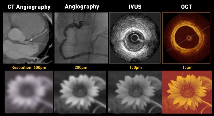 OCT vs IVUS The Results Are In