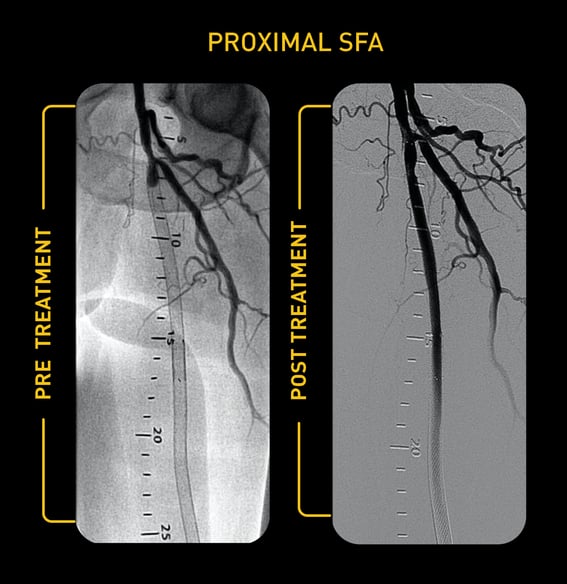 Proximal SFA-1